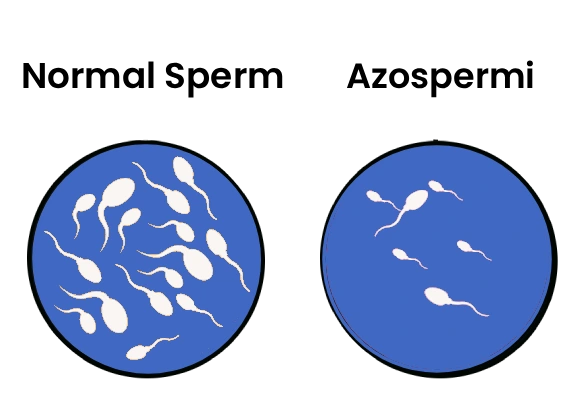 azospermi-587x396-1.webp
