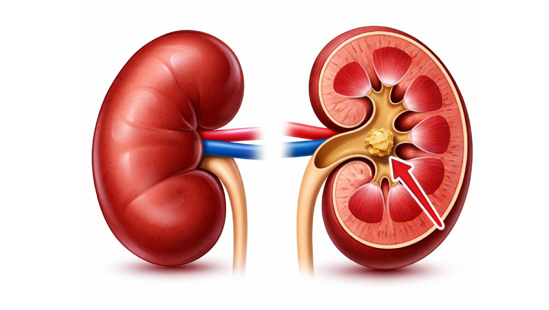 böbrek taşı neden olur